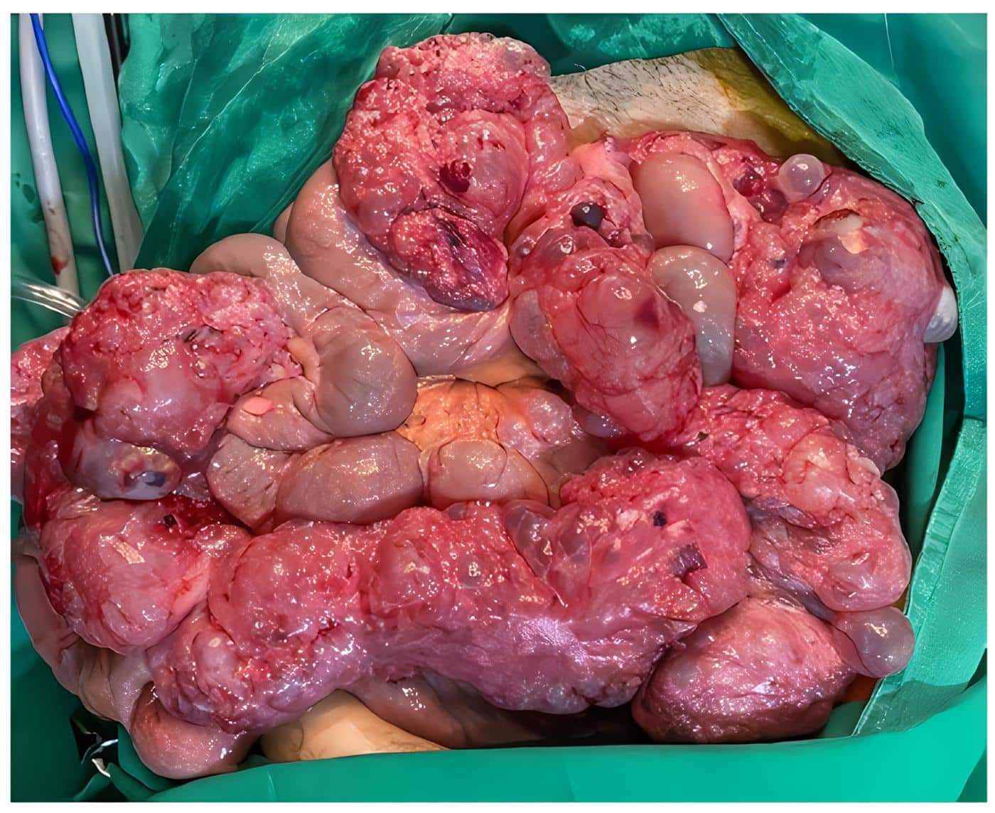 Neumatosis intestinal masiva del íleon