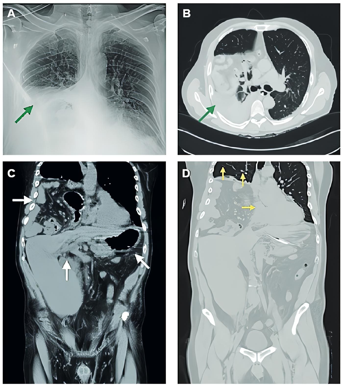  Radiografía  posteroanterior  con  opacidad  en  hemitórax  derecho.