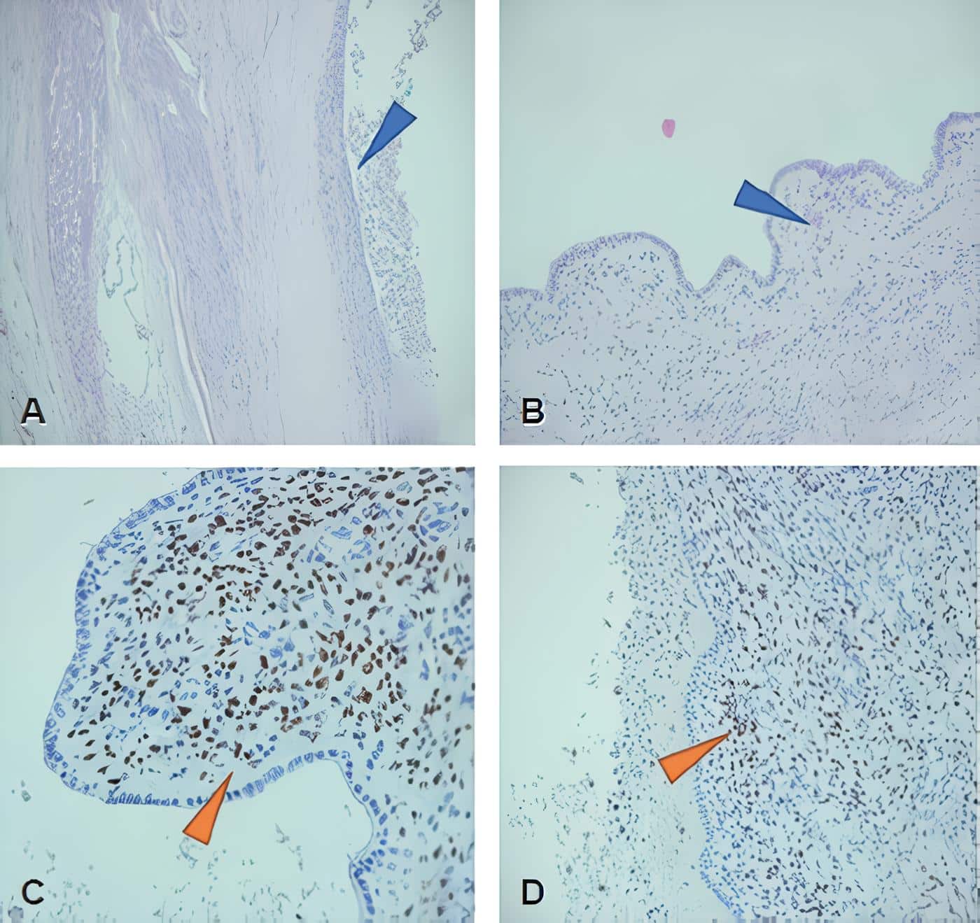 Presencia de estroma de tipo ovárico - Neoplasia Quística Mucinosa en la Vía Biliar Intrahepática