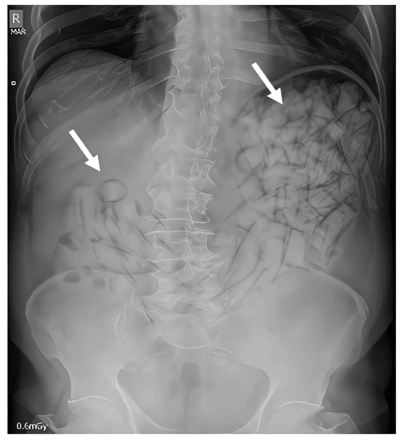 Síndrome Pilórico en un Body Packer - Radiografía  de  abdomen  simple