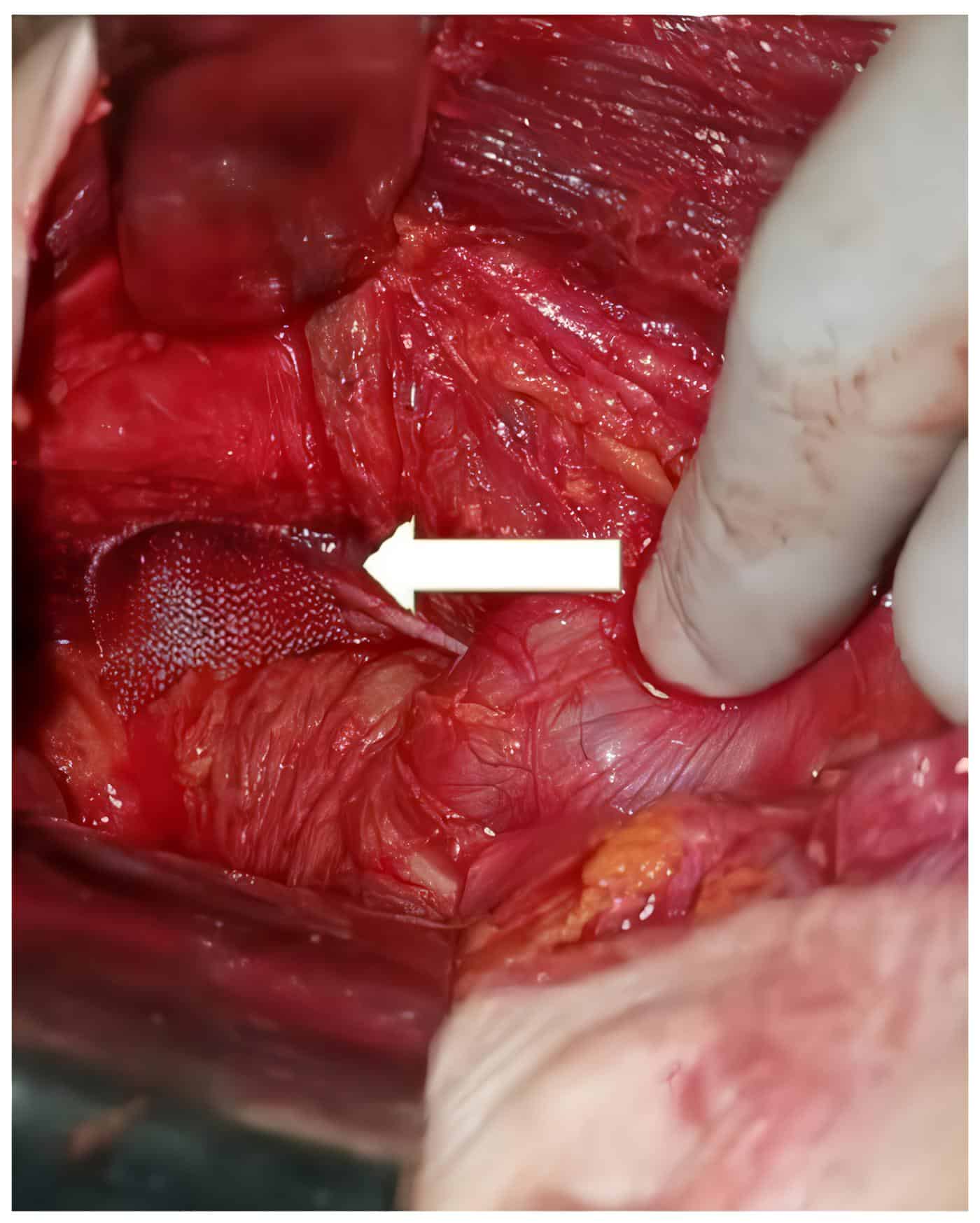 Reparación del defecto herniario, malla quirúrgica en el orificio obturador derecho