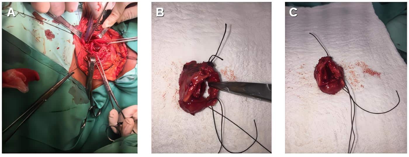 Resección de la lesión endoluminal pediculada durante el procedimiento quirúrgico