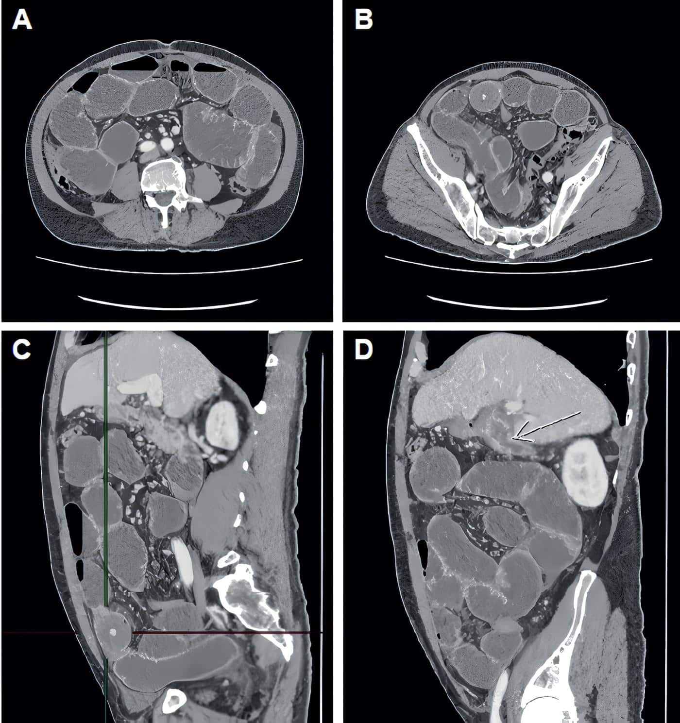 Tomografía computarizada de abdomen y pelvis