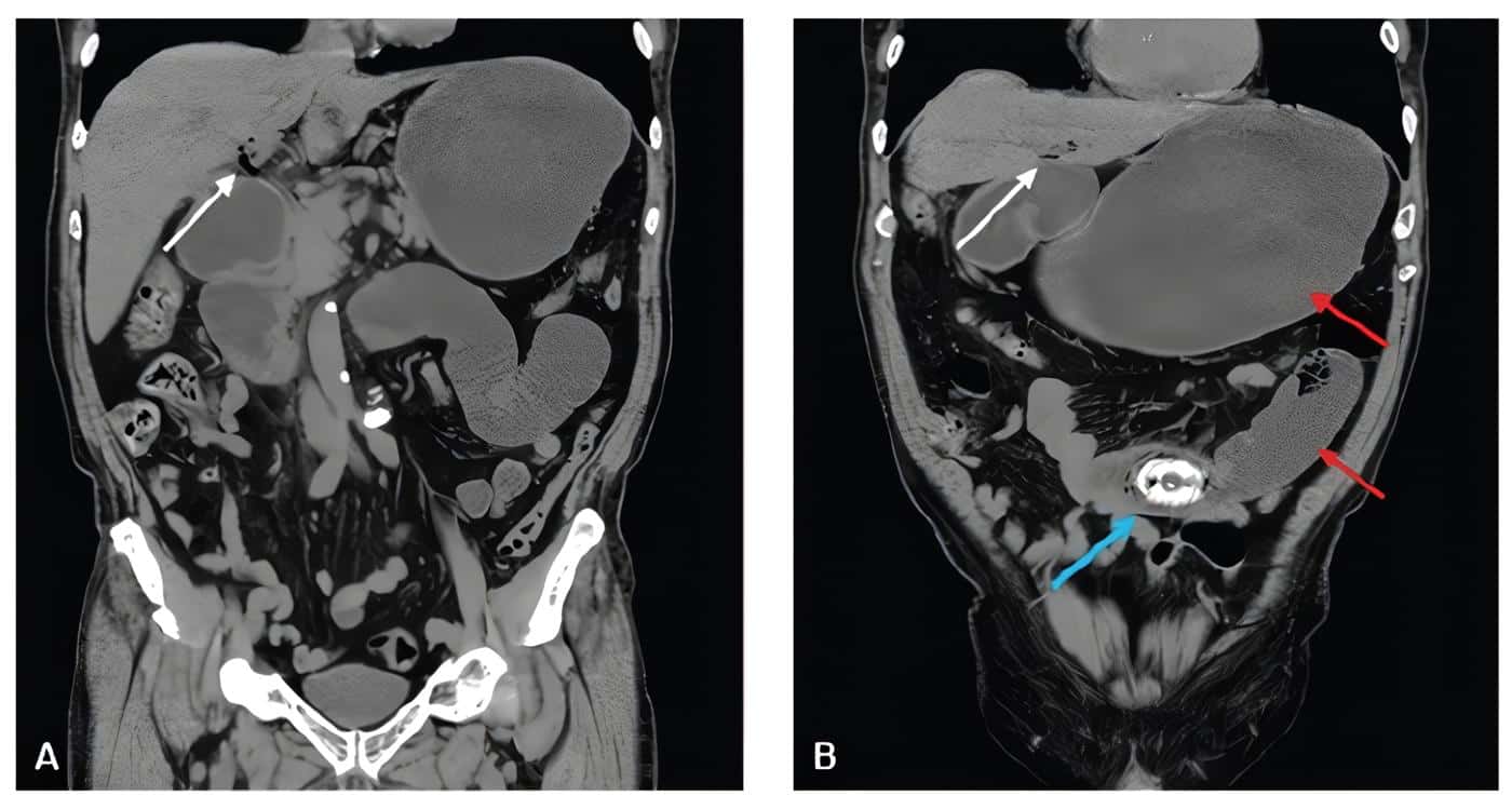 Tomografía abdominal simple en corte coronal - neumobilia
