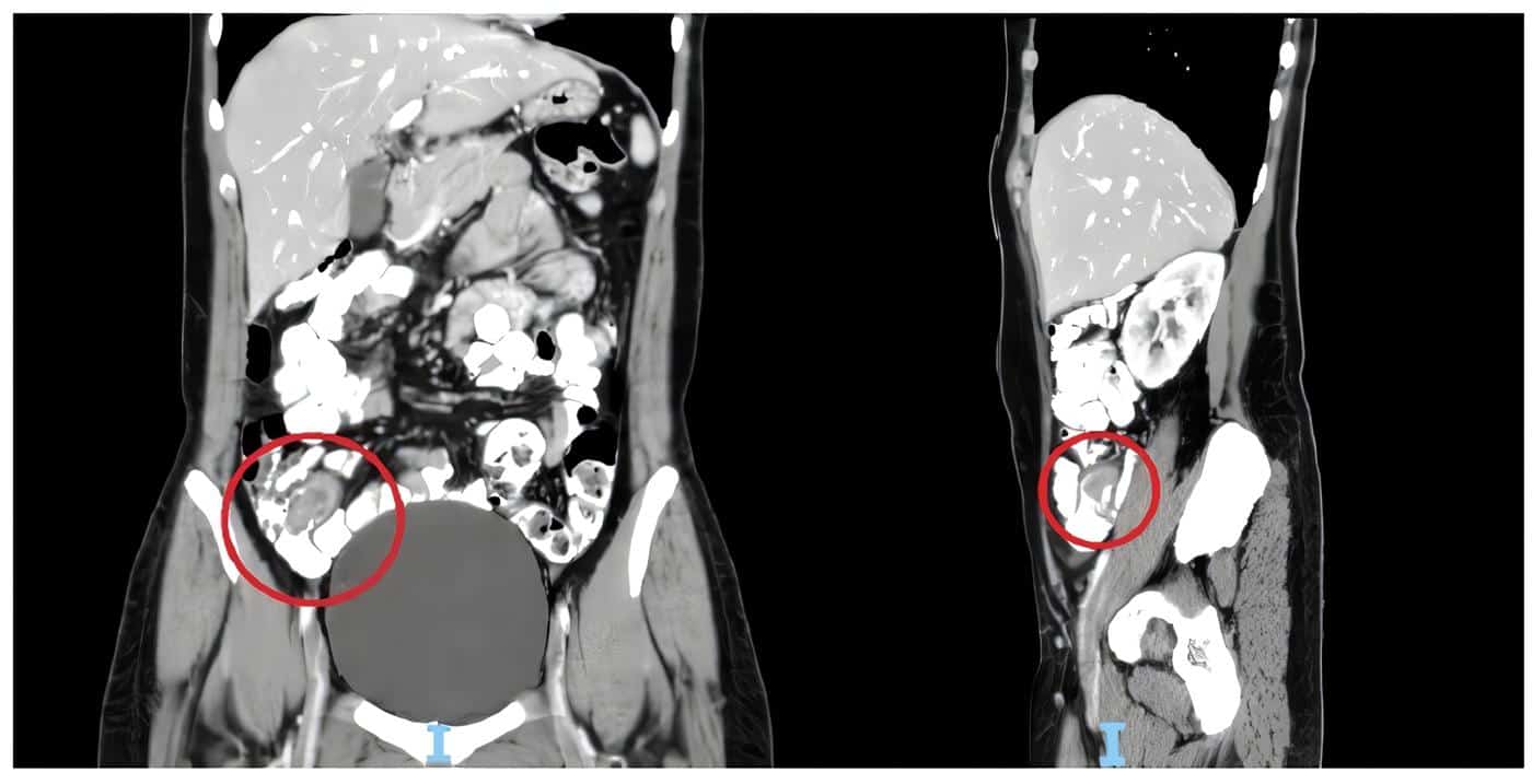 Tomografía computarizada de abdomen