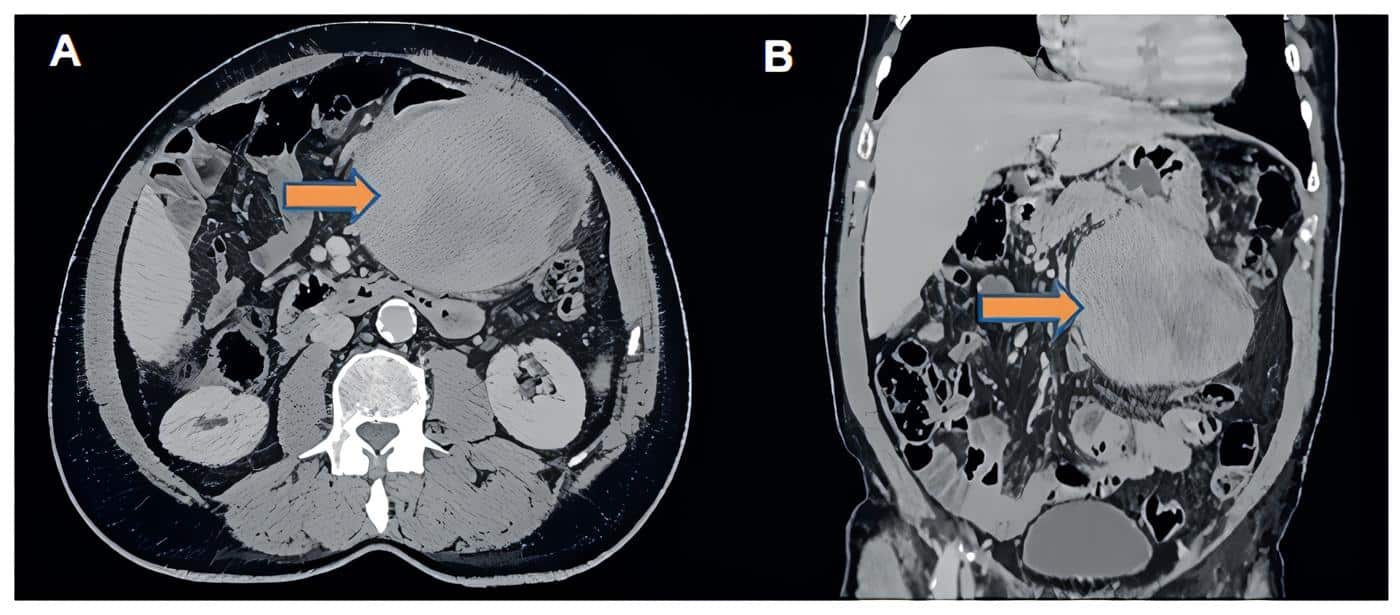 Tumor miofibroblástico inflamatorio gastrointestinal