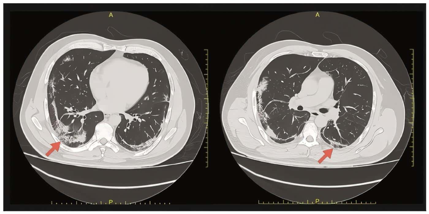 High-resolution chest computed tomography