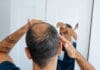 Tratamientos para hombres con calvicie o alopecia androgenética