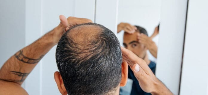 Tratamientos para hombres con calvicie o alopecia androgenética