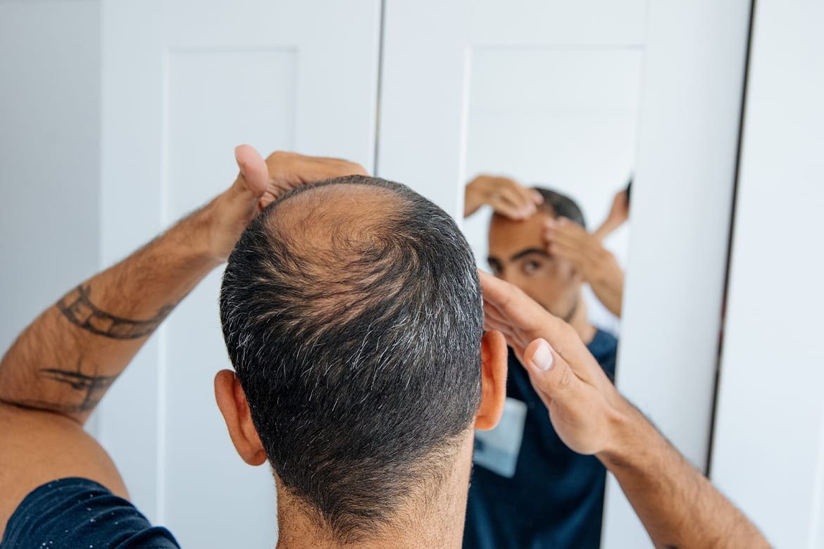 Tratamientos para hombres con calvicie o alopecia androgenética