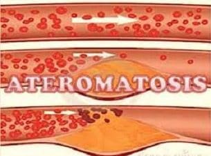 Ateromatosis