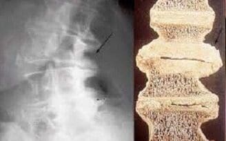 Discopatía Postraumática: Fijación Anterior de la Columna Torácica y Lumbar