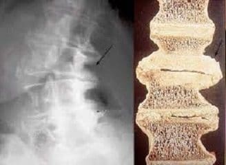 Discopatía Postraumática: Fijación Anterior de la Columna Torácica y Lumbar