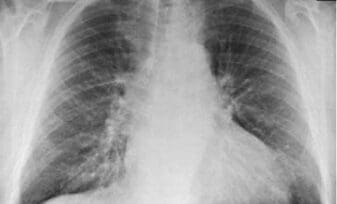 Nocardiosis Pulmonar y Paraproteinosis