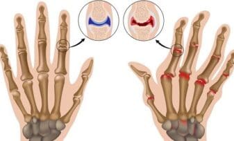 Artritis Reumatoide, Evaluación Pre y Post Operatoria Parte I