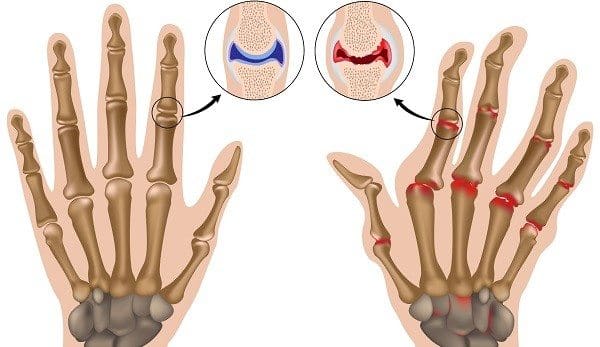 Artritis Reumatoide, Evaluación Pre y Post Operatoria Parte I