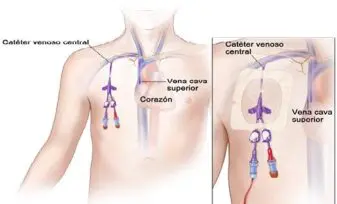 Complicaciones de la Cateterización Venosa Central Según la Vía de Inserción