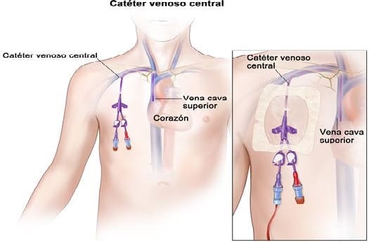 Complicaciones de la Cateterización Venosa Central Según la Vía de Inserción