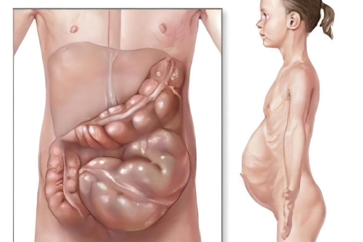 Enfermedad de Hirschsprung, Embriología