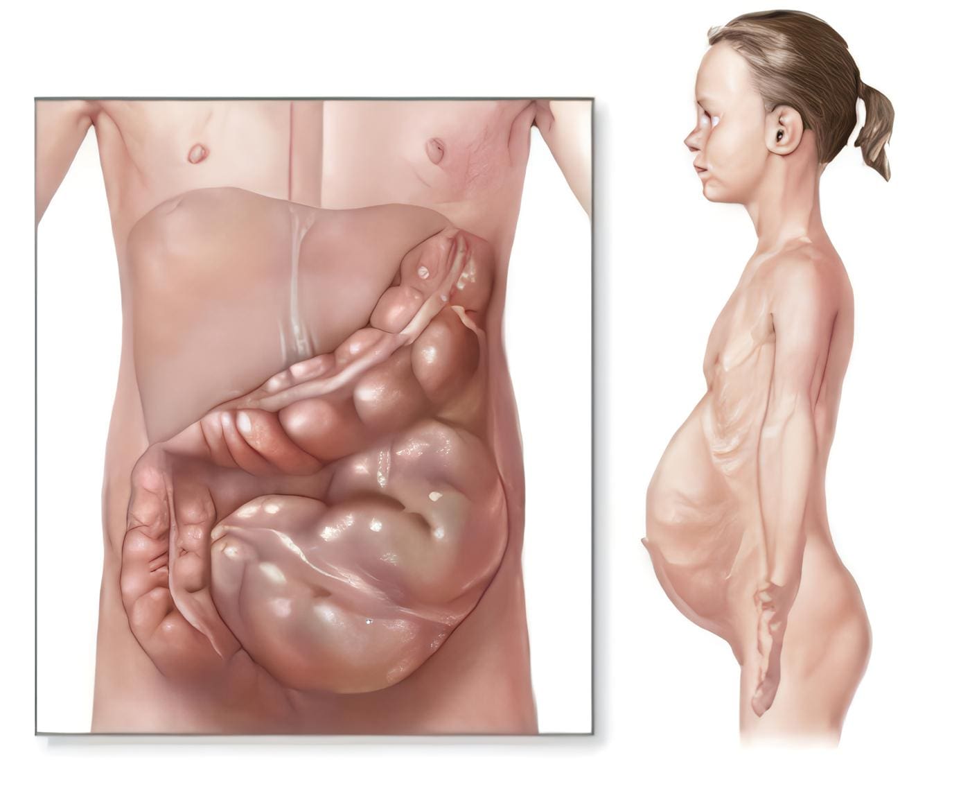 Enfermedad de Hirschsprung, Embriología