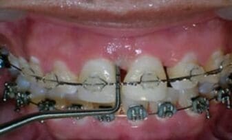 Técnicas de Pcr y Cultivo para la Identificación de las Especies Periodontopáticas