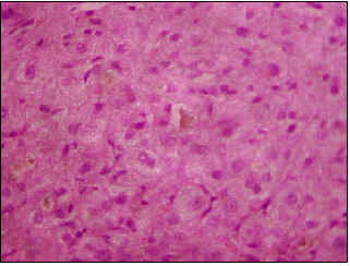 Colestasis Intrahepática Benigna Recurrente