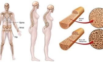 Hiperprolactinemia, Anovulacion y Osteoporosis