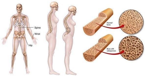 Hiperprolactinemia, Anovulacion y Osteoporosis