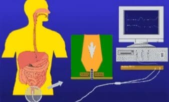 Enfermedad de Hirschsprung, Manometría Ano-Rectal