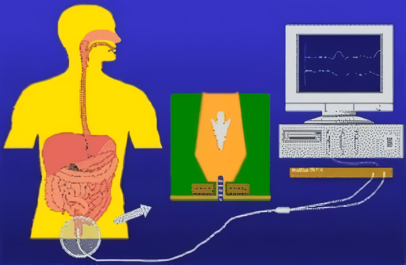 Enfermedad de Hirschsprung, Manometría Ano-Rectal