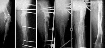 Distrofia Simpática Refleja y Fracturas del Extremo Distal del Radio