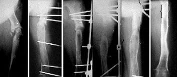 Distrofia Simpática Refleja y Fracturas del Extremo Distal del Radio