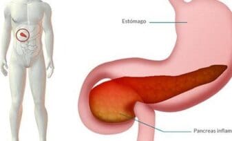 Fisiopatología de Pancreatitis Aguda