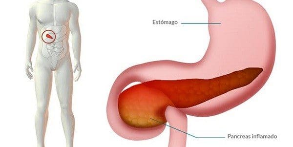 Fisiopatología de Pancreatitis Aguda