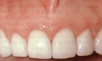 Biopsias de Tejido Gingival