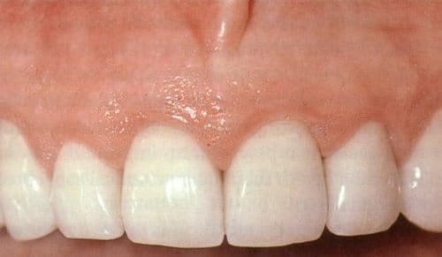 Biopsias de Tejido Gingival