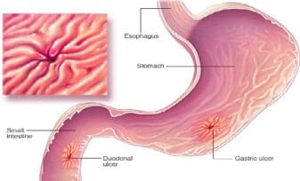 Hemostasia de Úlceras Sangrantes