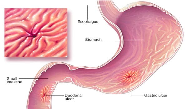 Hemostasia de Úlceras Sangrantes