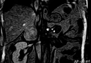 Carcinoma de Células Renales en un Paciente Pediátrico