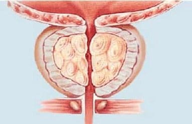 Retención Urinaria Aguda por Hiperplasia Prostática Benigna