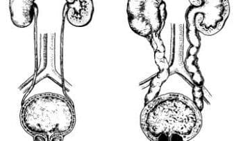 Evaluación Urodinámica Pre y Post Tratamiento con Doxazosina en Pacientes con Hiperplasia Prostática Benigna (HPB)