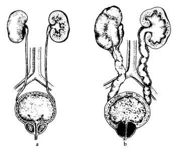 Evaluación Urodinámica Pre y Post Tratamiento con Doxazosina en Pacientes con Hiperplasia Prostática Benigna (HPB)