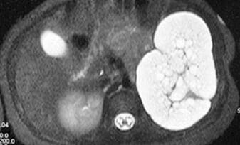 Displasia Renal Multiquística Segmentaria