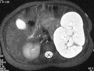 Displasia Renal Multiquística Segmentaria