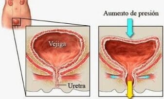 La Uretrocistopexia Suprapúbica Tipo Burch por Laparoscopia