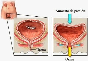 La Uretrocistopexia Suprapúbica Tipo Burch por Laparoscopia