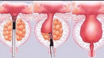 Stent intraprostático más Finasteride