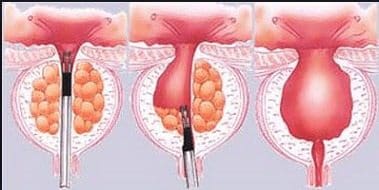 Stent intraprostático más Finasteride