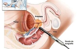 Sindrome de Resección Transuretral de Próstata