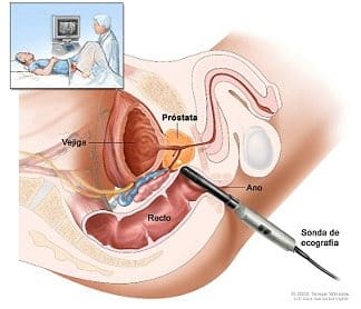 Sindrome de Resección Transuretral de Próstata